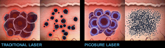 Illustration of traditional laser tattoo removal and Picosure