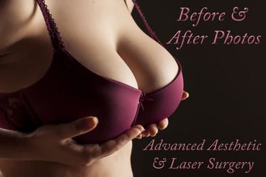 Breast Augmentation Surgery Columbus, Ohio