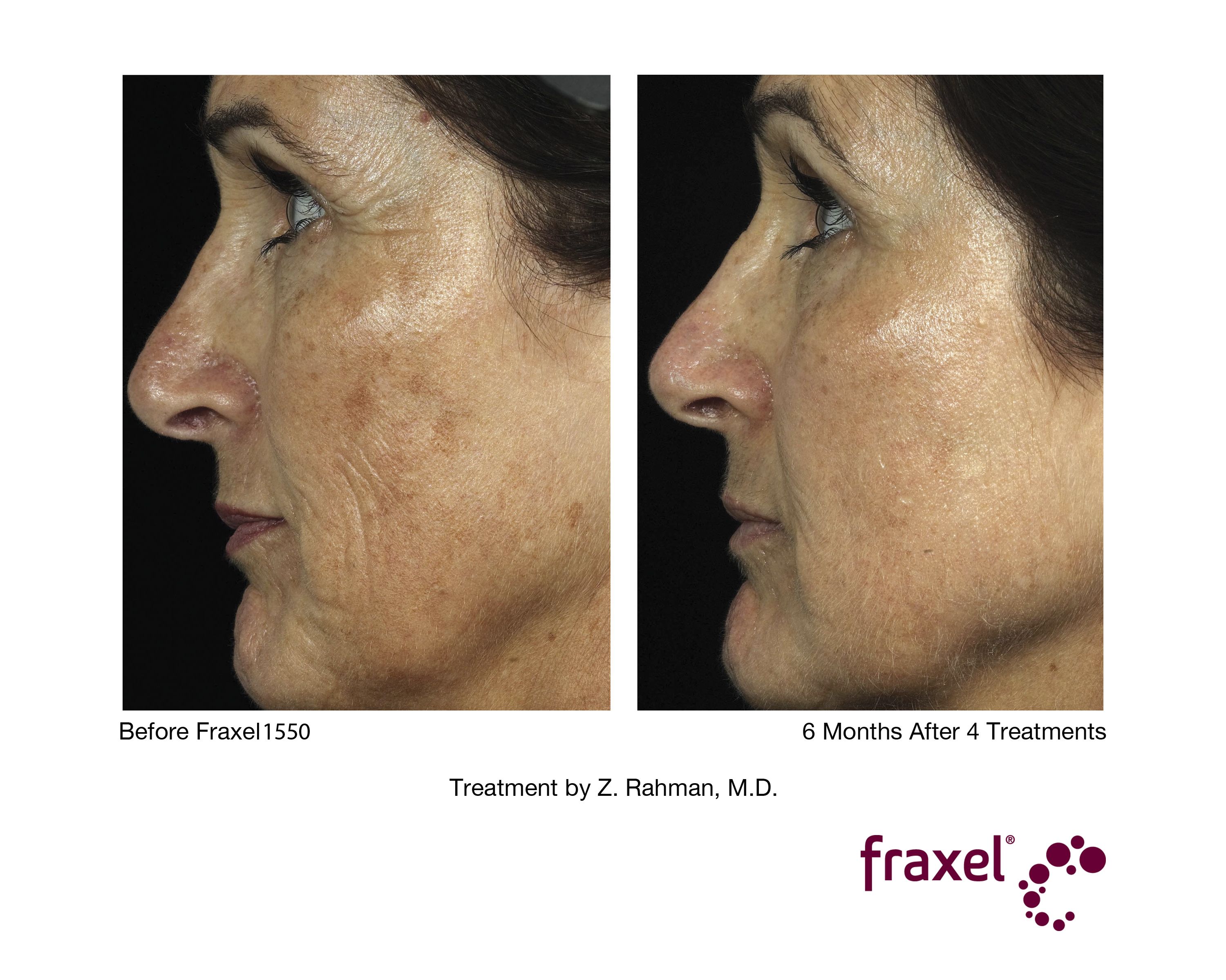 6 Months After 4 Fraxel Treatments