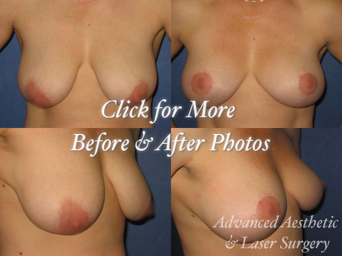 Woman getting a Breast Lift in Columbus, OH