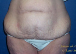 Post-Bariatric Body Contouring Results Columbus, OH
