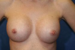 Silicone Implant Results Columbus OH