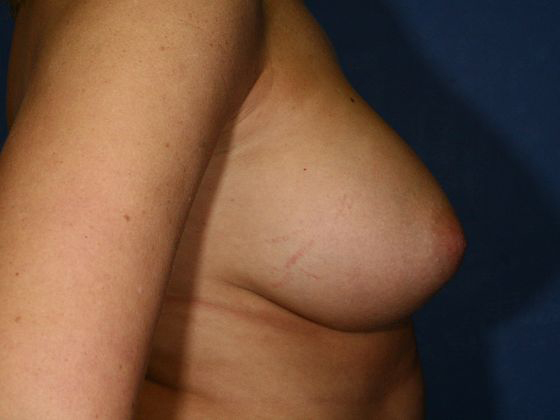 Breast Augmentation/Breast Implants