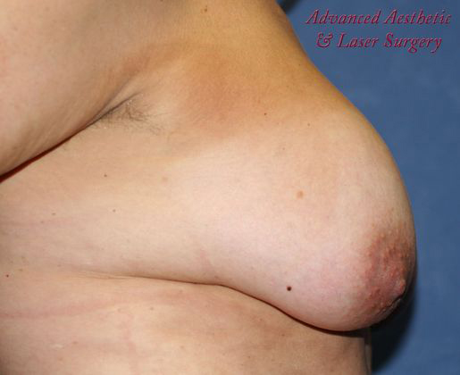 Breast Augmentation/Breast Implants