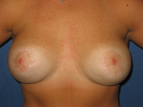 Mastopexy/Breast Lift