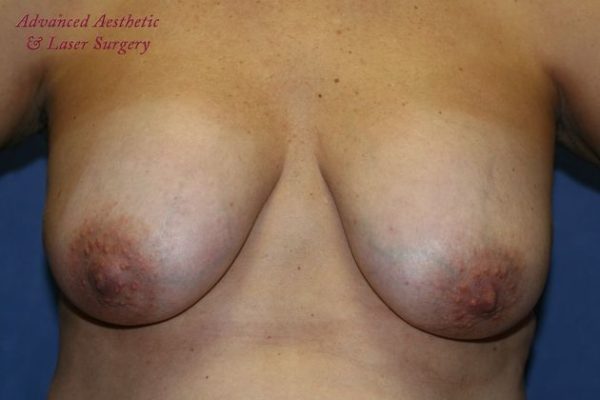 Mastopexy/Breast Lift