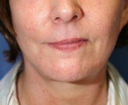 Face & Neck Lifts