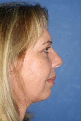 Face & Neck Lifts