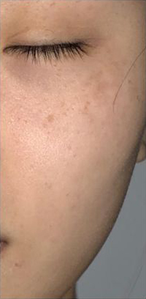 PicoSure® Focus Laser Skin Resurfacing