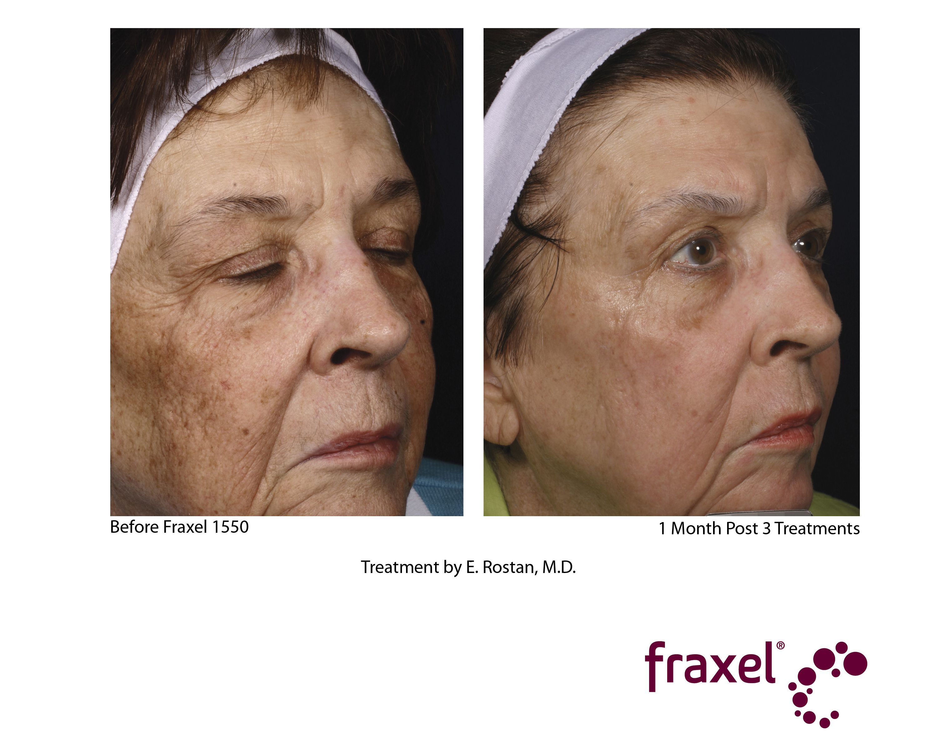 One Month Post 3 Treatments After Fraxel 1550