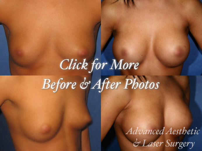Breast Implants in Columbus, OH
