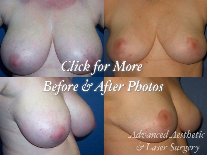 Breast Reduction Before & After