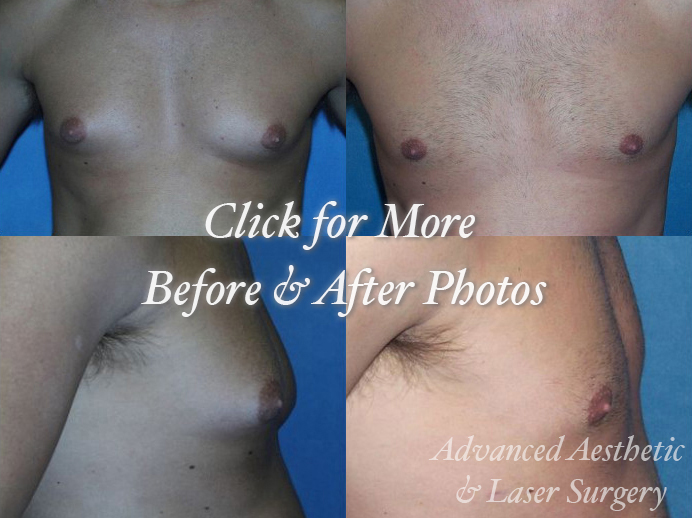 Male Breast Reduction Before & After