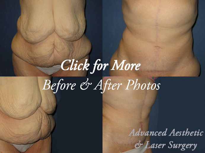 Body Contouring in Columbus, OH