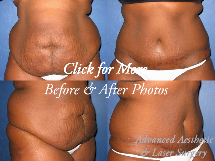 Liposuction in Columbus, OH