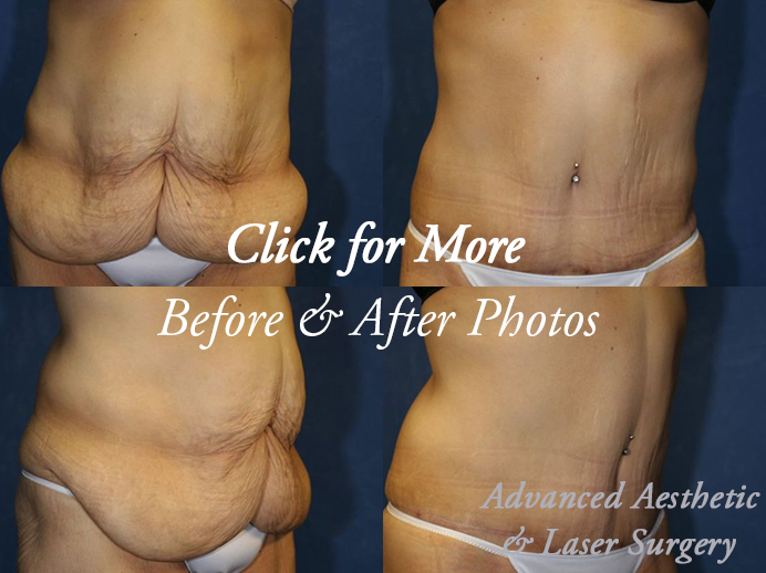 Tummy Tuck in Columbus, OH