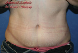Tummy Tuck Results Columbus OH